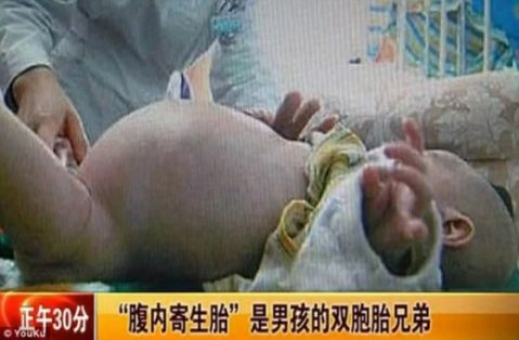 2 - годишно дете в китай роди със секцио близнака си